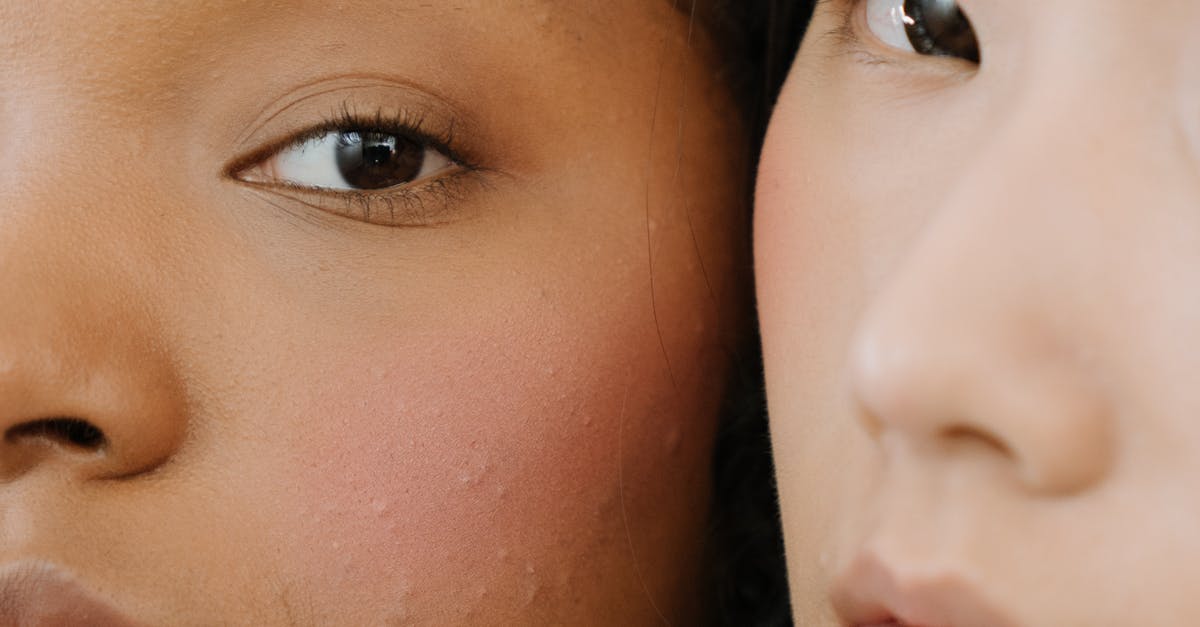Managing Discomfort After Laser Treatments: Best Practices