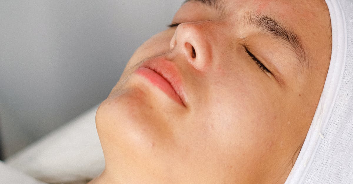 Microdermabrasion and Its Positive Impact on Acne Scarring